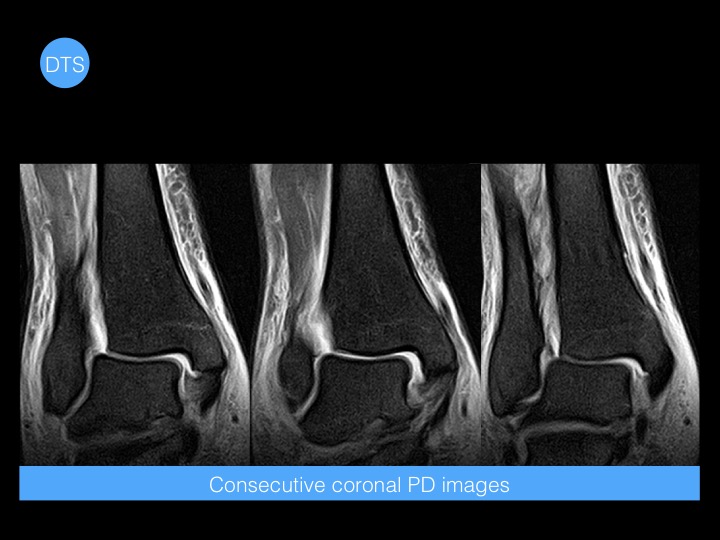 Figure 2 for case High ankle sprain Acute complete rupture of the syndemotic ligament complex